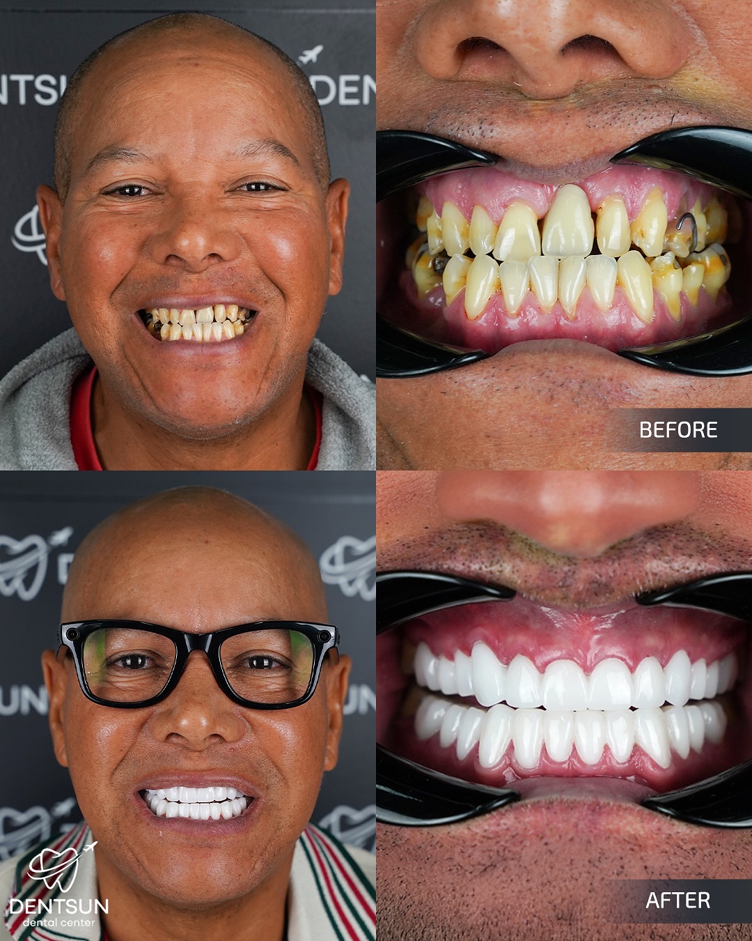 ✨ A bright smile that reflects confidence ✨
Our patient from Portugal and Israel chose BL1 shade Zirconium Crowns for a clean, luminous look. With the expertise of our dental team, we crafted a flawless smile that combines elegance, natural beauty, and long-lasting brilliance.
📞 +90 (540) 003 35 36
🔗 dentsun.com.tr