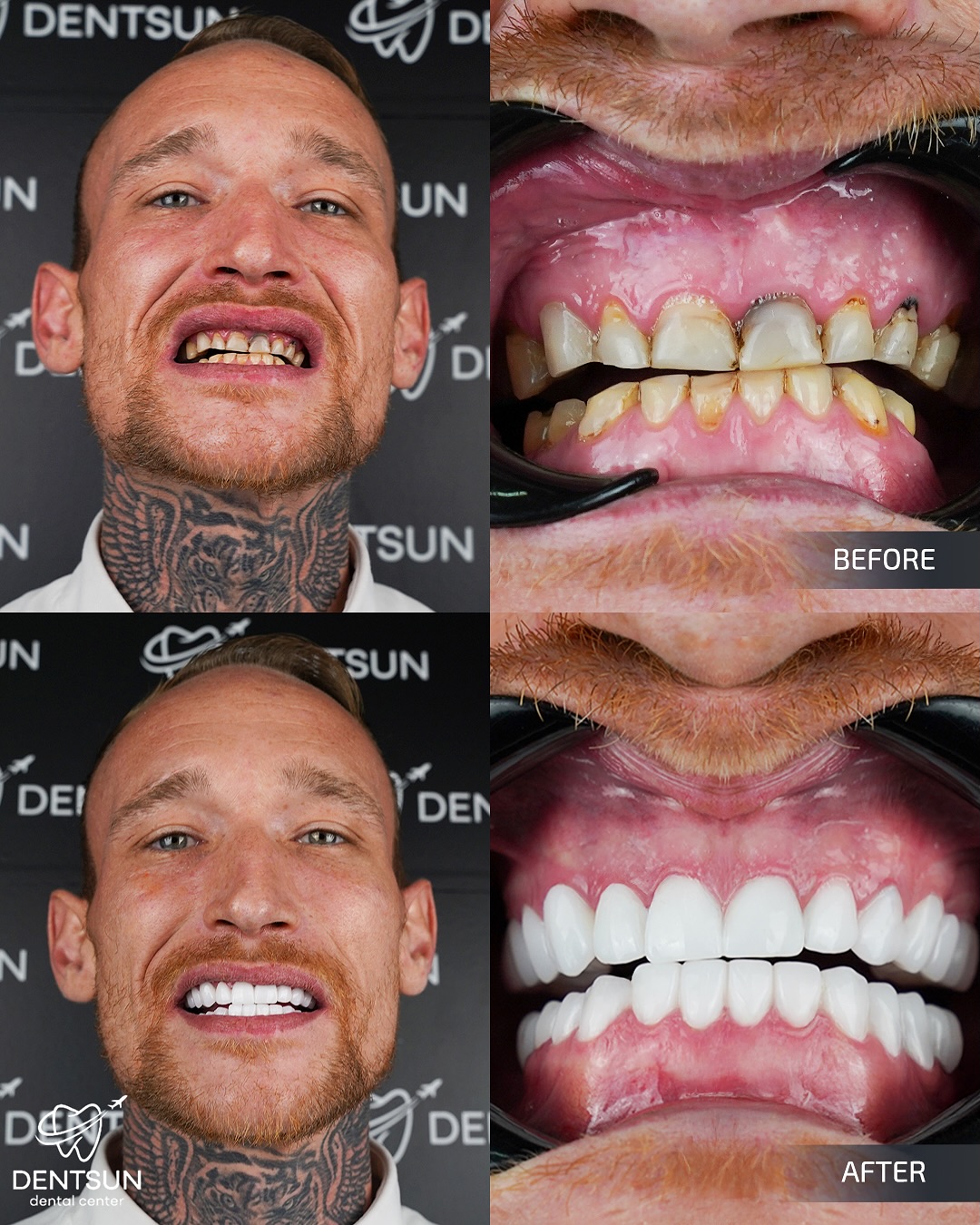 ✨ Johnson’s Smile Transformation ✨
Johnson trusted Dentsun Dental Center to design his dream smile.
Using BL1 shade Zirconium Crowns, our expert team crafted a clean, bright, and natural look that enhances both elegance and confidence. Now Johnson’s smile reflects perfection with every detail.
📞 +90 (540) 003 35 36
🔗 dentsun.com.tr