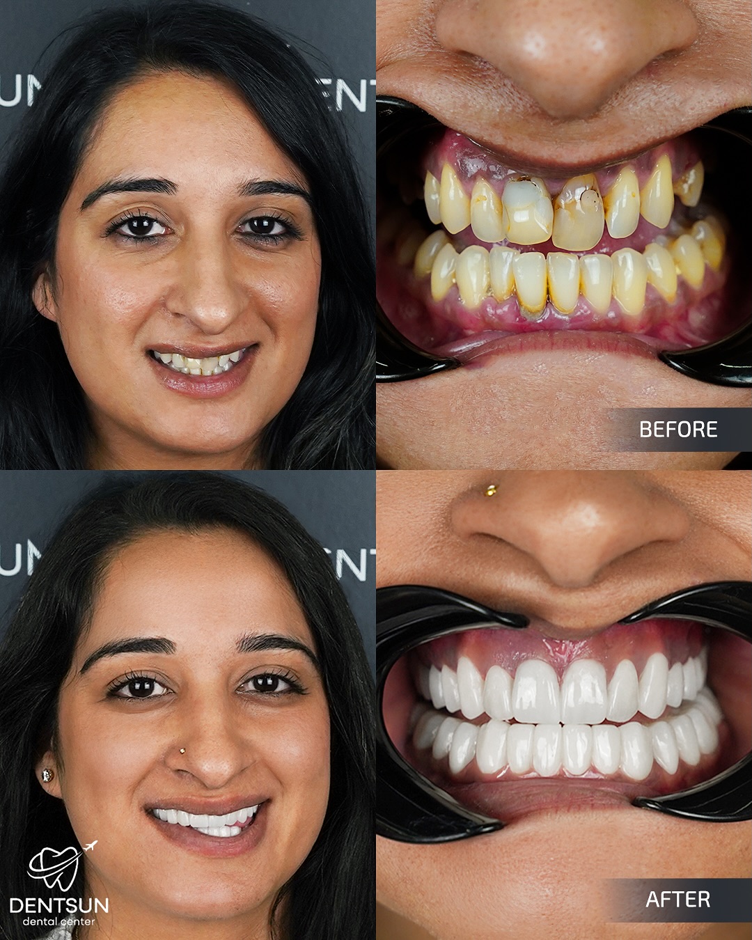 ✨ Zahra’s Smile Transformation ✨
Zahra from the Netherlands trusted Dentsun Dental Center to achieve her dream smile.
With BL4 shade Zirconium Crowns, we designed a natural and elegant look that perfectly complements her features. Subtle, soft, and full of confidence  Zahra’s new smile reflects true harmony.
📞 +90 (540) 003 35 36
🔗 dentsun.com.tr