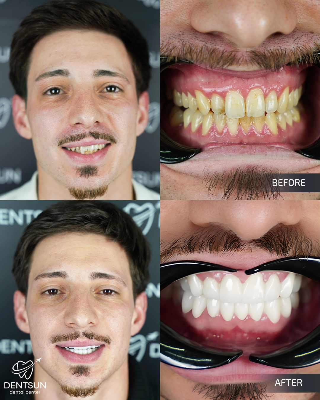 ✨ Diego’s Smile Transformation ✨
Diego trusted Dentsun Dental Center to restore his confidence with a brighter, healthier smile.
Through a complete smile makeover using Zirconium Crowns, we replaced years of discoloration and wear with a clean, radiant, and perfectly aligned design. Diego’s new smile is more than just aesthetic — it’s a renewed expression of self-assurance.
📞 +90 (540) 003 35 36
🔗 dentsun.com.tr