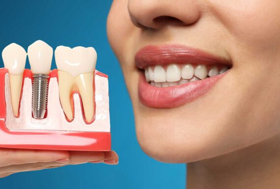 Dental İmplant